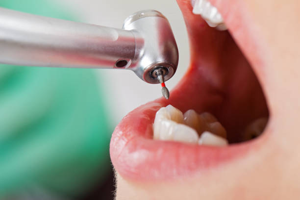 Best Emergency Dental Extractions in Cary, NC